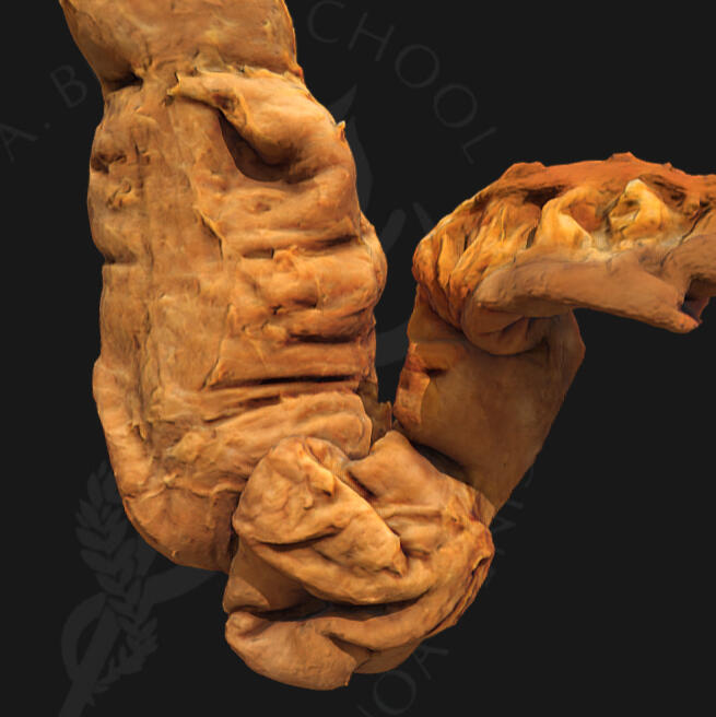Intussusception Intussusception