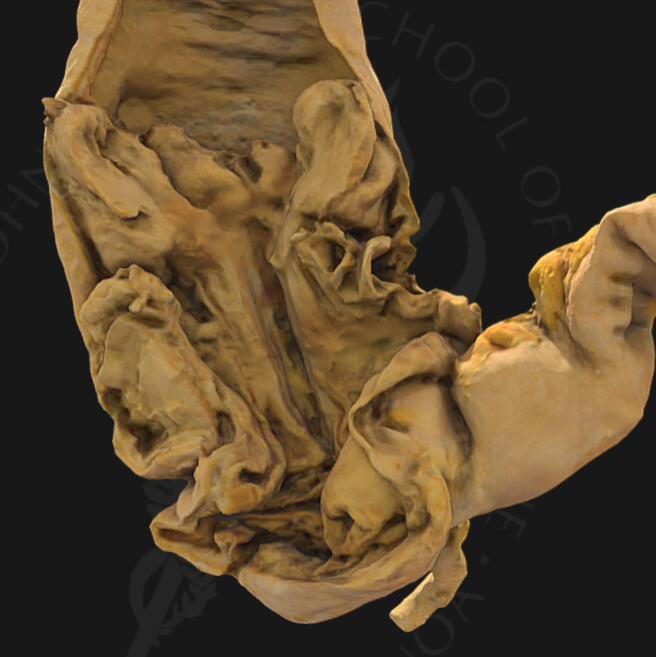 Intussusception (Full Window)