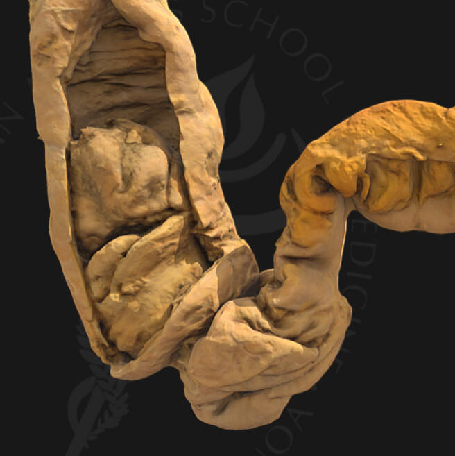 Intussusception (Open Window)